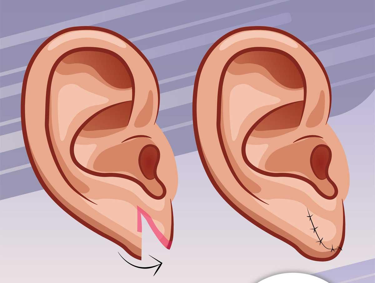 Cómo cerrar las dilataciones de la oreja